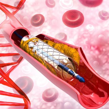 Complex coronary angioplasties